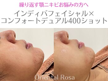オリエンタルローザ 表参道(Oriental Rosa)/ニキビケア/毛穴ケア/赤ら顔改善