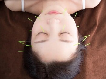 はやかわ鍼灸整骨院の写真/眼精疲労・頭痛・肩こりに鍼灸で根本アプローチ！自律神経の乱れケア◎心身ともに深いリラックスをご体感♪