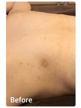 ピリナ 名古屋/【背中ハーブピーリング】症例