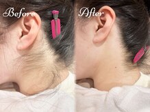 ピミル(PIMIL)/うなじ脱毛