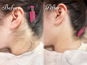 ピミル(PIMIL)/うなじ脱毛