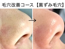 ベアトリーチェ 五反田(Beatrice)/【毛穴改善コース】黒ずみ毛穴