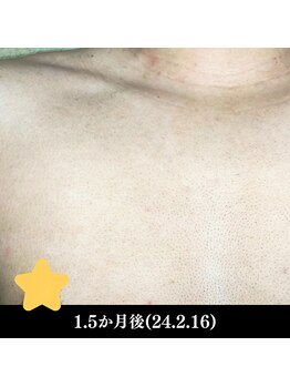 レイ(R.E.I)/【脱毛アフター】胸