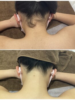 セラス(CERAS)/えりあし脱毛