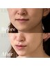【一度で変わりたい！水光肌と確実小顔】韓国肌管理×輪郭三点小顔調整¥28000