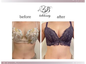 ベルビューティー(belle beauty)/バストアップ◇症例◇