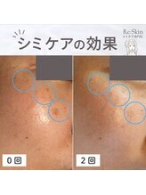 リスキン(Re:Skin)/