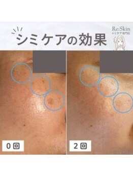 リスキン(Re:Skin)/