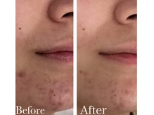 MMK/顎のニキビケアハーブピーリング