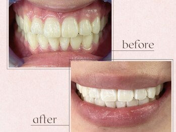 ルアナシンフォニア エクシア 池袋店(Luana-Sinfonia)/ホワイトニングビフォーアフター