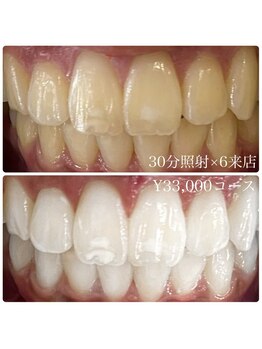 ホワイトニングルーム 横浜店(Whitening Room)/ホワイトニング/横浜