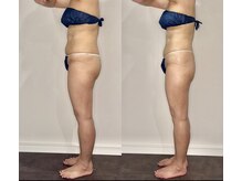 カルナ(CARNA)/【痩身】セルライトゼロ2