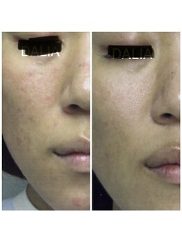 ダリア(DALIA)/敏感・乾燥肌