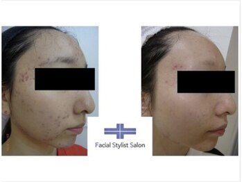 フェイシャルスタイリストサロン 四谷店/ケア例(34)