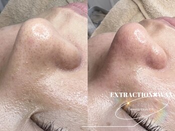 ワクシングトウキョウ アイス 池袋(waxing tokyo ice)/毛穴エクストラクション