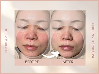 シンスプラス(SINCE+)/ニキビケア徹底フルコース