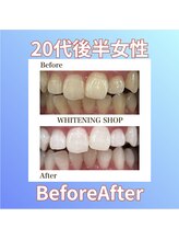 ホワイトニングショップ 西原店/20代後半女性☆BeforeAfter