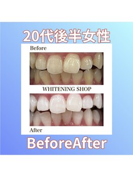 ホワイトニングショップ 西原店/20代後半女性☆BeforeAfter