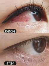 アン(AN)/アイケアホワイトニング