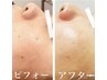 エステ+シミフォト+モデリングパック 75分