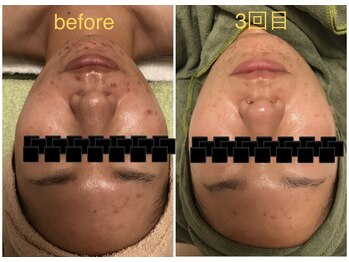 ココ(coco)/ハーブピーリング