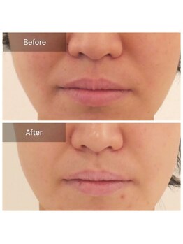 ファヴォリ(favori)/エイジング美肌美容液導入