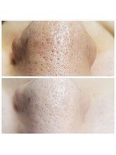 エターナル(Eternal)&nbsp;小鼻 綺麗