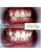 ホワイトニングサロン 名古屋駅店/【ホワイトニング施術例】