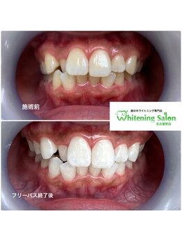 ホワイトニングサロン 名古屋駅店/【ホワイトニング施術例】