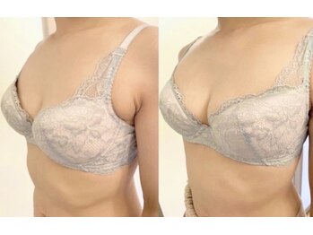 美人バスト 川崎店/バストアップ◇症例◇