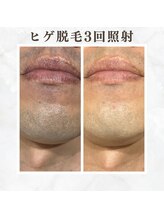 ボゴス(BOGOSS)/ヒゲ脱毛