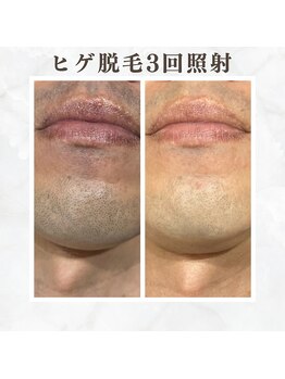 ボゴス(BOGOSS)/ヒゲ脱毛