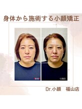 ドクターコガオ 福山店(Dr.小顔)/☆施術２回目の変化☆