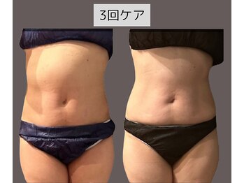 ウナ 福岡店(UNA)/モニター様★お腹撃退2カップ