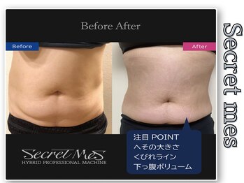 ルアナ(Luana)/お腹ビフォーアフター