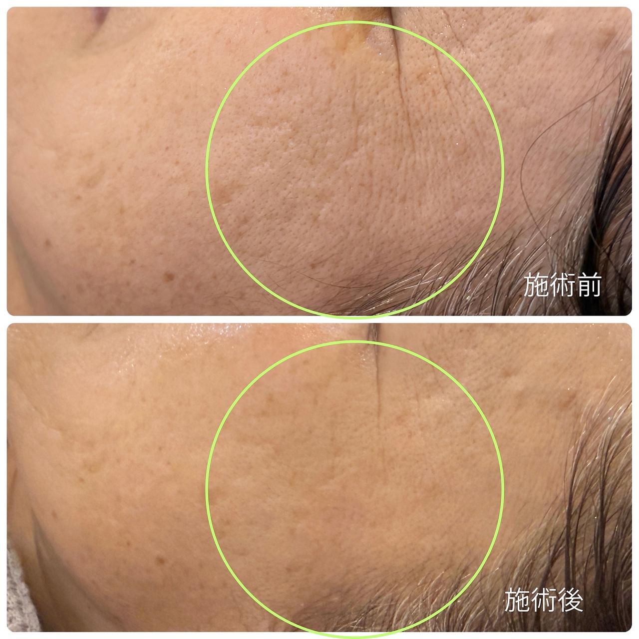 チョチョワンプラス(緒々one+)/乾燥による目元の小じわを改善