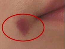 ハリエッセンス(HARI ESSENCE)/内出血のリスクについて