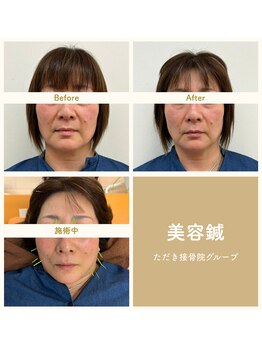 ただき接骨院 整体院 高崎本院/深層リフトケア美容鍼