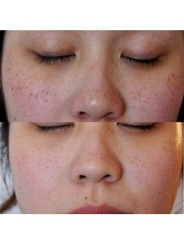 トラット エステアンドアイズ(tratto)/20代　お客様症例写真