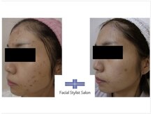 フェイシャルスタイリストサロン 四谷店/ケア例（35）