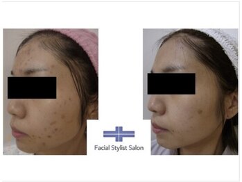 フェイシャルスタイリストサロン 四谷店/ケア例(35)