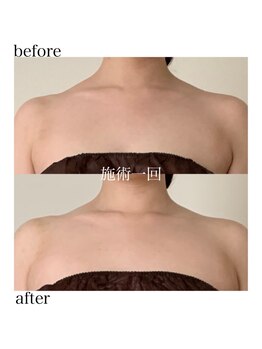 オン(On)/綺麗なバストライン♪