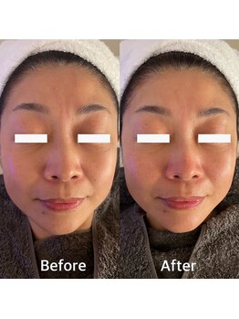 シエルビ(Ciel B)/徹底毛穴+保湿ケア施術効果★