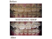 ホワイトニングショップ 明石大久保店/【BeforeAfter】