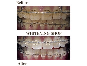 ホワイトニングショップ 明石大久保店/【BeforeAfter】