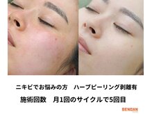 洗顔サロン 池袋(SENGAN)/剥離ハーブピーリング　