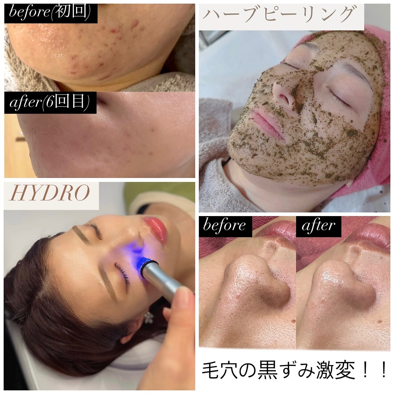 エレクトロポレーション　エステ エレクトロポレーション エステ - メルカリ