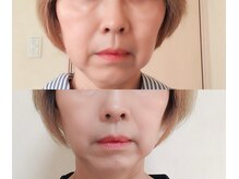 ほうれい線が薄く！（50代）