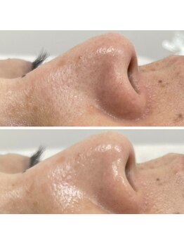 カルディエ(Cardie)/肌質改善　ビフォーアフター