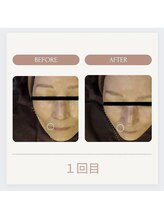 美々庵/光フェイシャル◆